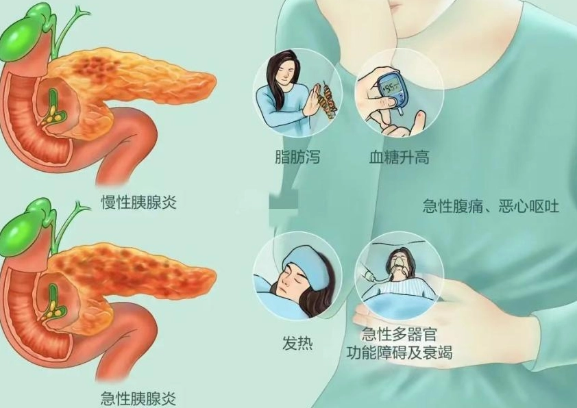 急性胰臟炎飲食