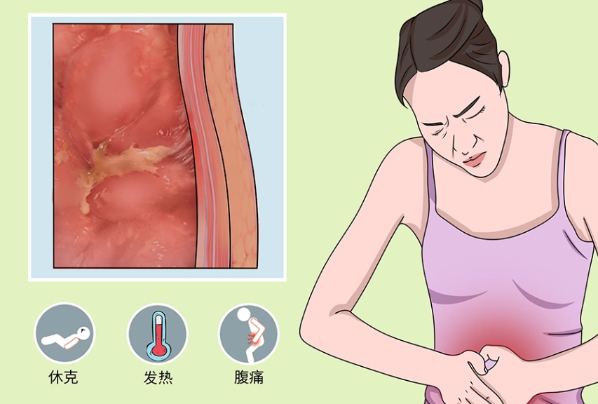 腹膜炎原因
